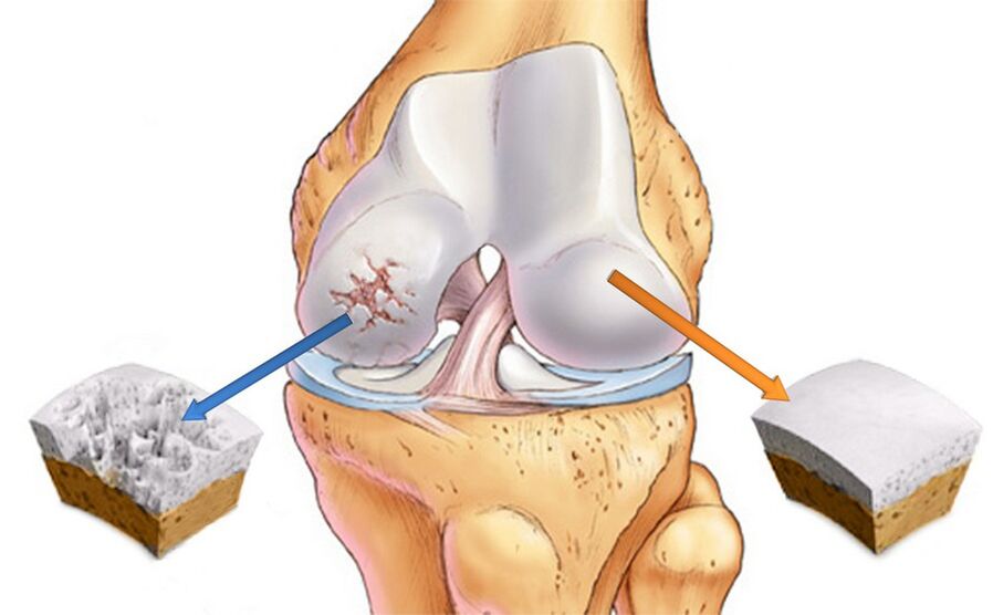 Knee joint osteoarthritis