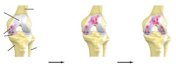 The degree of osteoarthritis of the knee joint
