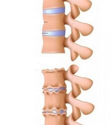 Stages of osteochondrosis ramps from the neck