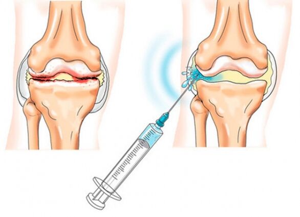 intra-articular injections for osteoarthritis of the knee