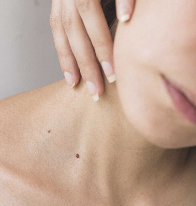 Stiffness in the neck is one of the symptoms of the initial stage of osteochondrosis of the cervical spine.