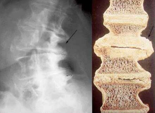 Damage to the vertebrae in thoracic osteochondrosis.