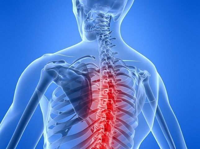 osteochondrosis of the thoracic spine
