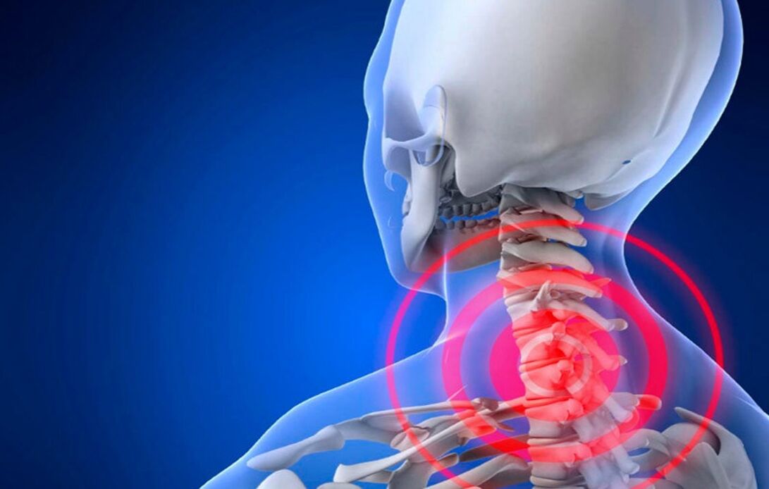 osteochondrosis of the cervical spine